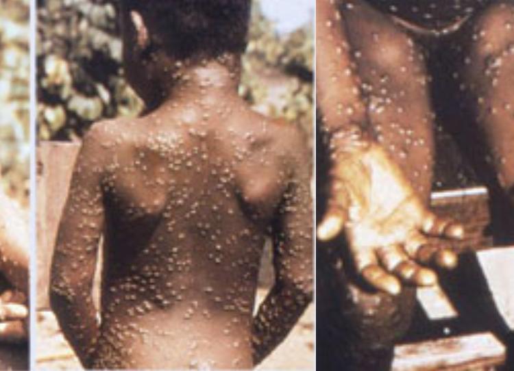 OMS registra 237 casos no mês e afirma que surto pode ser contido. Fonte: CDC